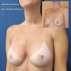 Implantes mamas - Dra. Natalia Solimano