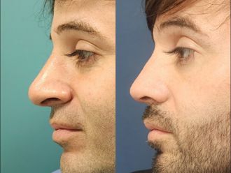 Rinoplastia antes y después - 870772