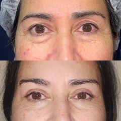 Blefaroplastía + pexia de cejas - Dra. Natalia Solimano