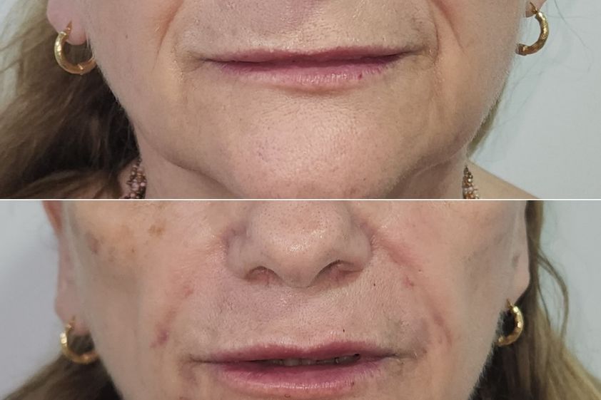 Rellenos faciales antes y después - 870975