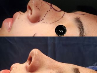 Rinoplastia antes y después - 871433