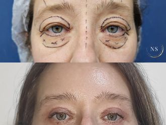 Blefaroplastia antes y después - 871634