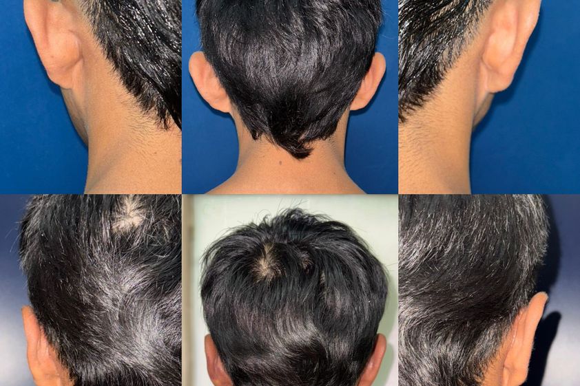 Otoplastia antes y después - 871635