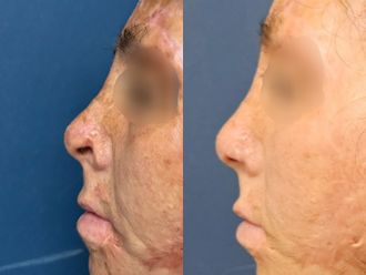 Rinoplastia antes y después - 871636