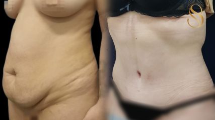 Abdominoplastía - Dra. Natalia Solimano