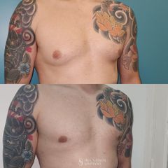 Cirugía de ginecomastia - Dra. Natalia Solimano