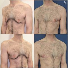 Cirugía de ginecomastia - Dra. Natalia Solimano