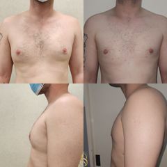 Cirugía de Ginecomastia - Dra. Natalia Solimano