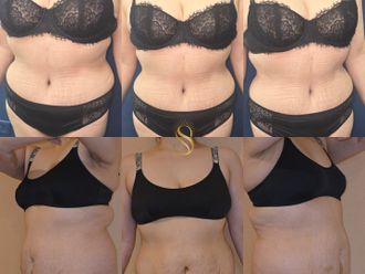 Abdominoplastía antes y después - 876857