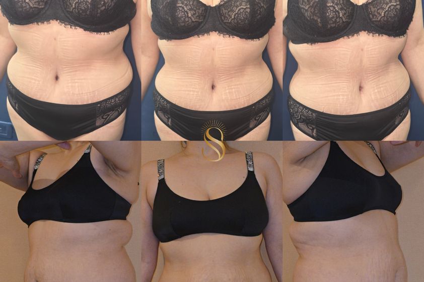 Abdominoplastía antes y después - 876857