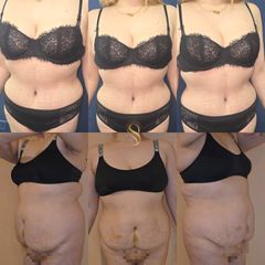 Lipoabdominoplastía - Dra. Natalia Solimano
