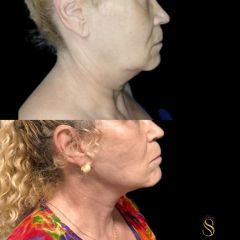 Lifting facial y cervical - Dra. Natalia Solimano