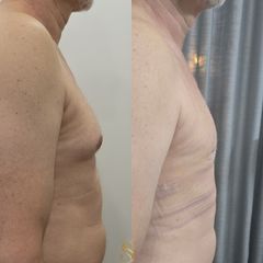 Cirugía de ginecomastia - Dra. Natalia Solimano