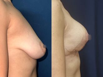 Mastopexia antes y después - 876860