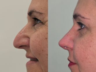 Rinoplastia antes y después - 876866