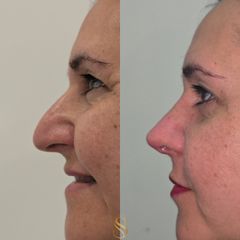 Rinoplastía estructurada - Dra. Natalia Solimano