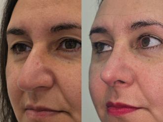 Rinoplastia antes y después - 876867