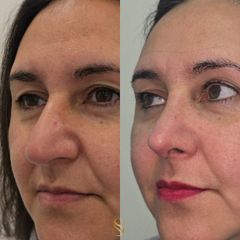 Rinoplastía - Dra. Natalia Solimano