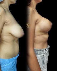 Mastopexia - Dra. Natalia Solimano