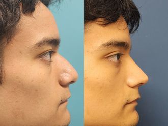 Rinoplastia antes y después - 876938