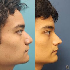 Rinoplastía masculina - Dra. Natalia Solimano