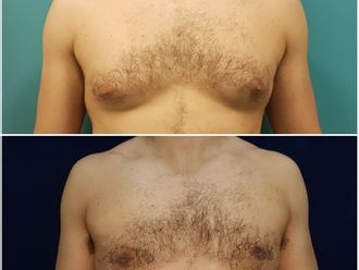 Ginecomastia antes y después - 876953