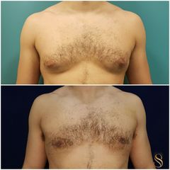 Cirugía de ginecomastia - Dra. Natalia Solimano