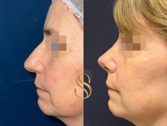 Rinoplastia antes y después - 877116