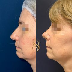 Rinoplastía estética - Dra. Natalia Solimano