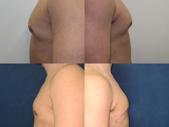 Ginecomastia antes y después - 878067