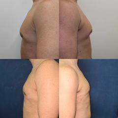 Cirugía de ginecomastia - Dra. Natalia Solimano