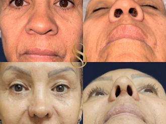 Rinoplastia antes y después - 879291