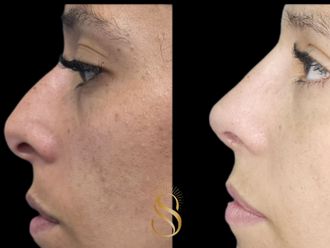 Rinoplastia antes y después - 879345