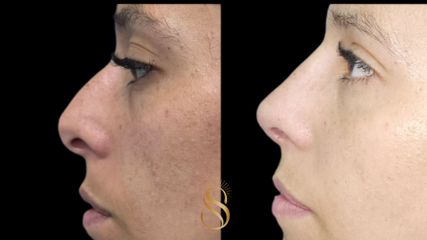Rinoplastia - Dra. Natalia Solimano