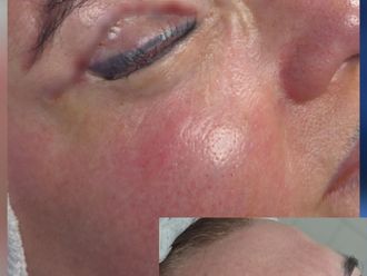 Blefaroplastia antes y después - 879560