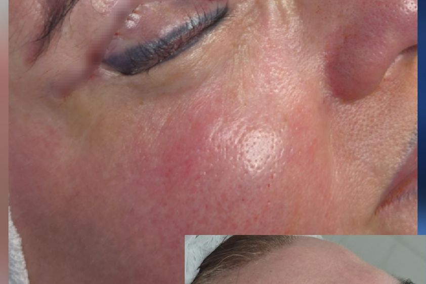 Blefaroplastia antes y después - 879560