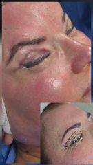 Levantamiento de cejas