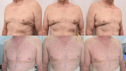 Toracoplastía estética masculina