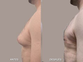 Ginecomastia antes y después - 880320