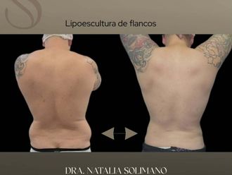 Lipoescultura antes y después - 880795