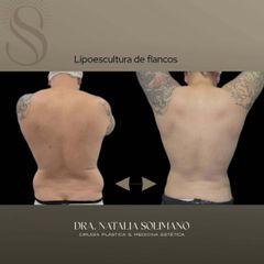 Lipoescultura selectiva - Dra. Natalia Solimano