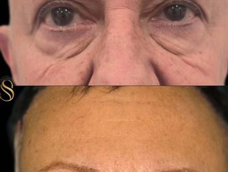 Blefaroplastia antes y después - 880796