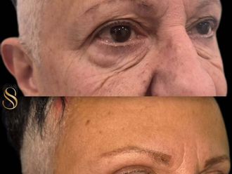 Blefaroplastia antes y después - 880797