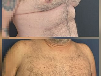 Ginecomastia antes y después - 881429