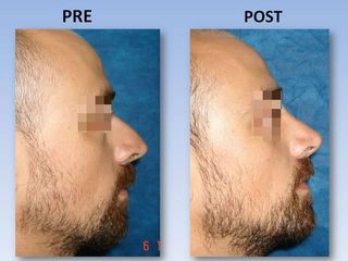 Rinoplastia