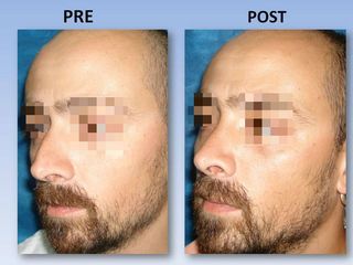 Rinoplastia