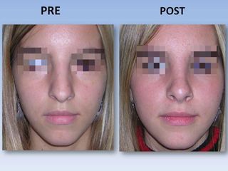 Rinoplastia