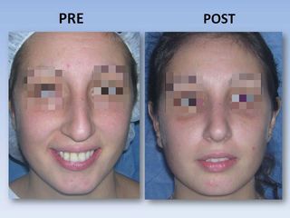 Rinoplastia