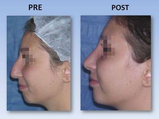 Rinoplastia