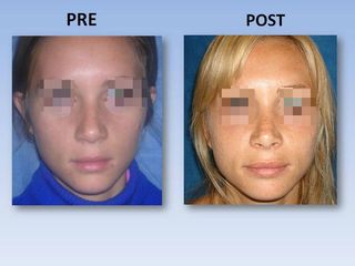 Rinoplastia